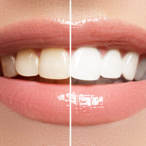 what you need to know about teeth whitening 1