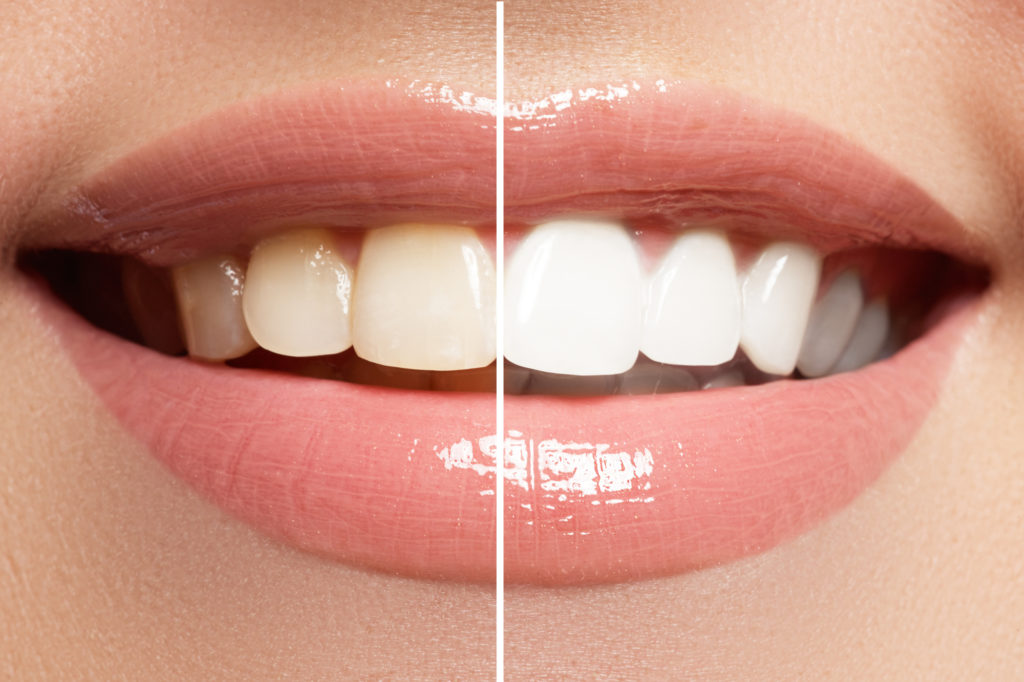 what you need to know about teeth whitening 1